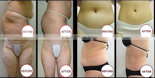 2016 professional Hot sell high quality cryotherapy body slimming machine