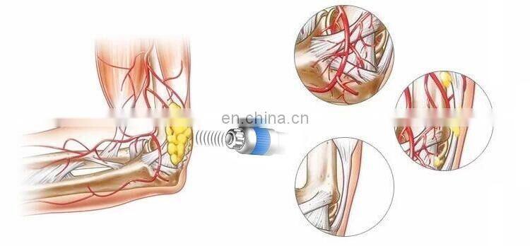 Portable machine  Low intensity shock wave therapy erectile for ed