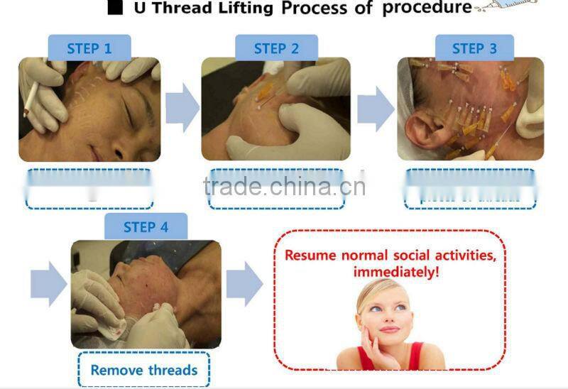 Cog face lifting PDO Thread