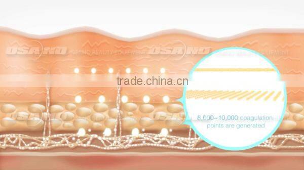 Osano LM-S809A High Frequency Operation System Slimming Hifu Machine