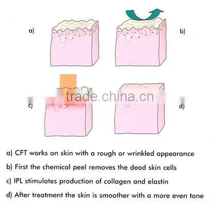 Super hair removal ipl machine made in germany with top quality