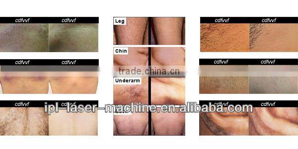 fda approved ipl hair removal,ipl machine portable mini,home use ipl permanent hair removal equipment