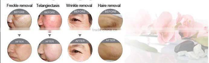 AFT OPT high technology high quality hair removal pigmentation removal SHR IPL beauty equipment