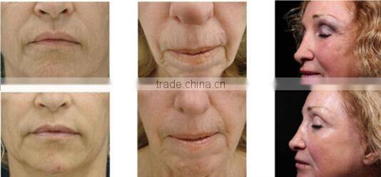 Professional Derma Meso Pen for Skin Micro-needling