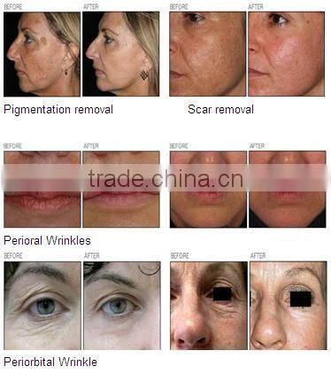 Vaginal tighten Fractional co2 laser Vaginal tightening