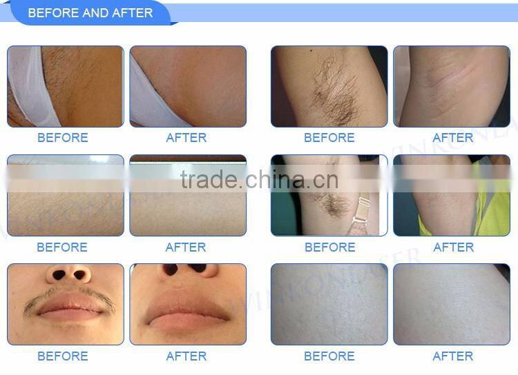 Factory price ! germany imported laser bar / Diode 808 laser removal with perfect cooling system