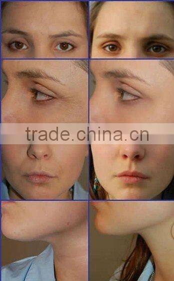 skin tightening radio frequency machine