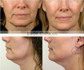 good market for ipl shr Elight nd yag pore removal laser with long pulse 1064nm