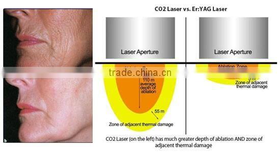 Professional CO2 Fractional Laser Machine For Women Skin Resurfacing POP IPL FC10