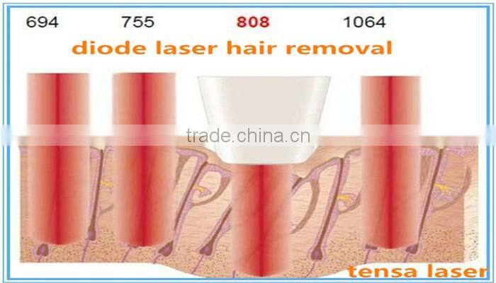 distributor wanted europe 808nm diode laser hair removal speed 808