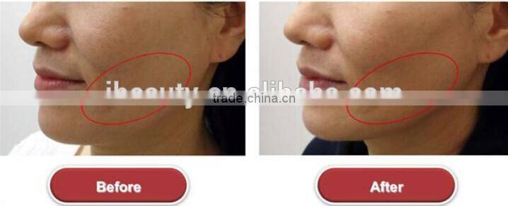 2015 Most Popular Lift Eyes&Brows Remove Crows Feet & Pouches High Intensity Focused Ultrasound Hifu