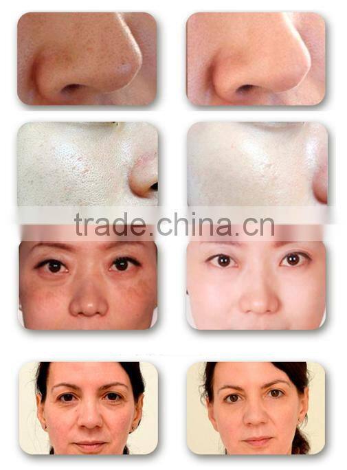 2016 home use rf skin tightening device rf multifunction beauty machine suppliers