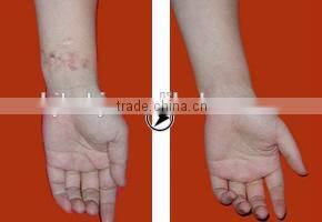 RF co2 franctional laser with auto intelligent controller for acne Scar remover
