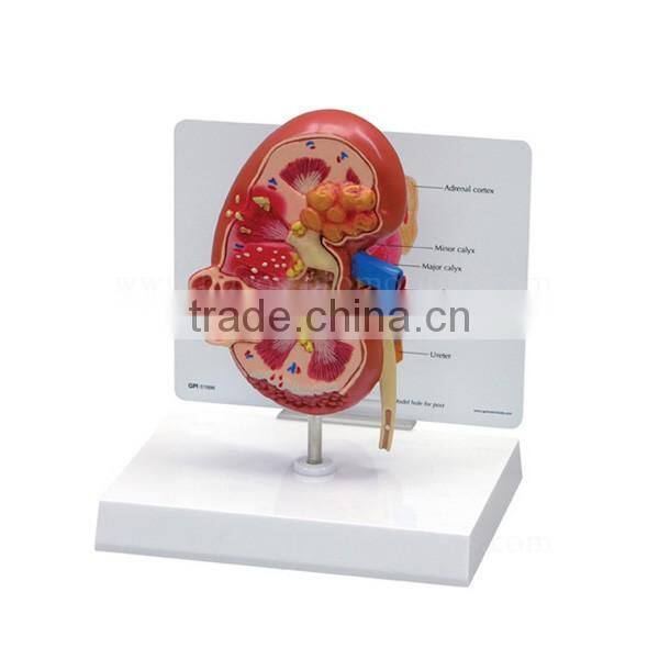 Pathological Medical Human Body Anatomy Model Kidney