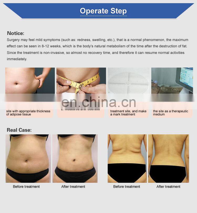 airsculpt reduct fat hifu fat removal liposonic machine