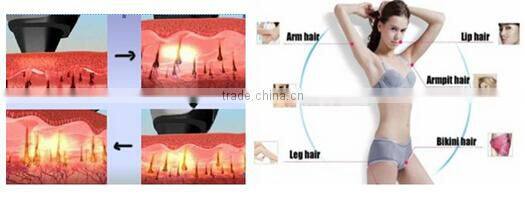 New designed two handles SHR fast hair removal ipl xenon flash lamp