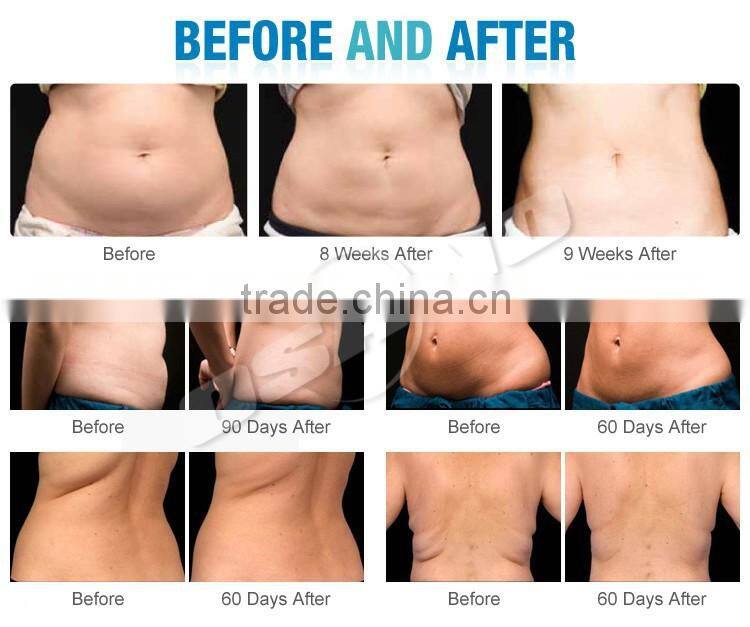 Multi-Function Beauty Equipment Type Cryolipolysis System