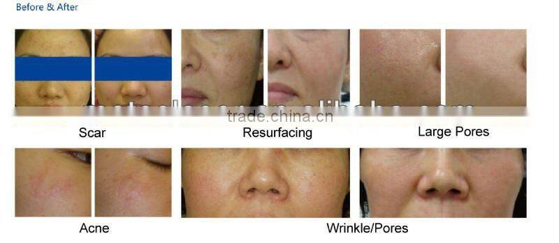 15W Portable fractional co2 cutting laser machine