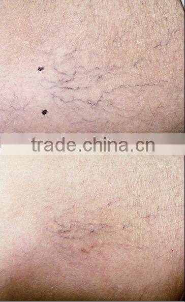 P001 effective clinique epilator hair removal laser
