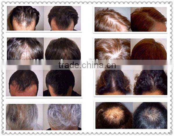 Hot selling instant hair growth equipment