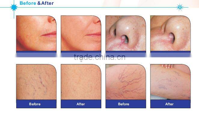 High Frequency Vascular Removal Machine