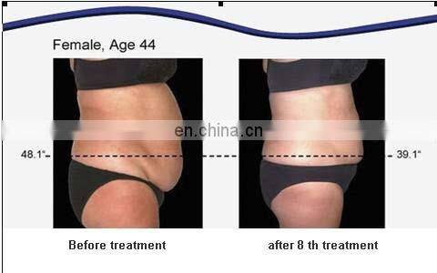 Shape body fat reduce machine for beauty salon