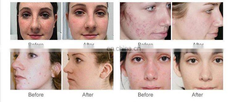 Multifunction aqua oxygen jet peeling skin rejuvenation 7 color led light therapy skin whitening machine