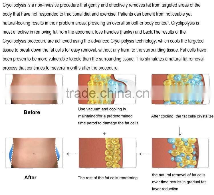 Body Sculpting Cavitation Cool Fat Freezing Cryo Slimming Lipolysis Equipement