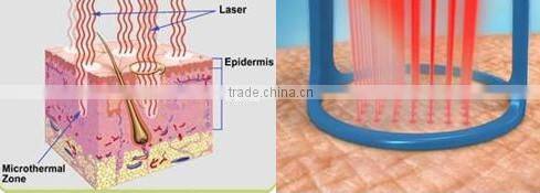 Nubway non-ablative fractional laser