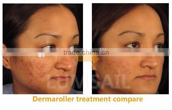 0.2 to 3.0mm micro needle derma roller 540 Titanium derma roller