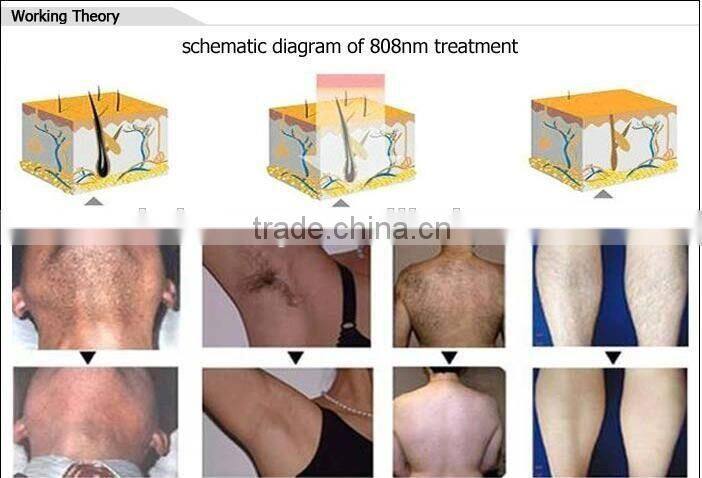 2016 portable newest diode 808nm laser hair removal machine with shots 10000000 times for clinic and beauty spa