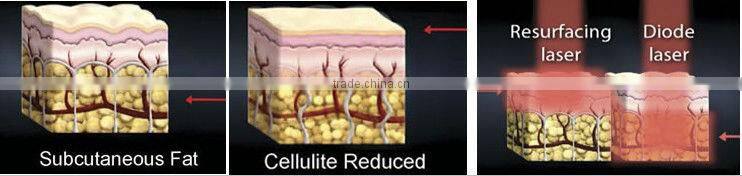 slimming cold laser for sale