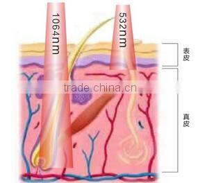 2014 Hottest sale q-switched nd yag laser tattoo removal machine nd yag laser korea