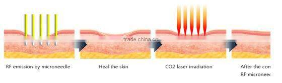 2 professional treatment handles radiofrecuencia fraccionada
