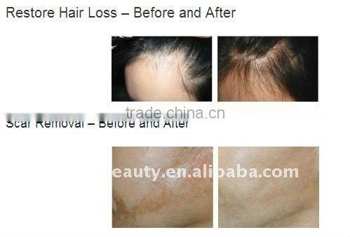 Medical Micro Needles Derma Roller L002