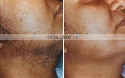 hair loss treatment- medical beauty equipment 1064nm long pulse laser nd yag P003