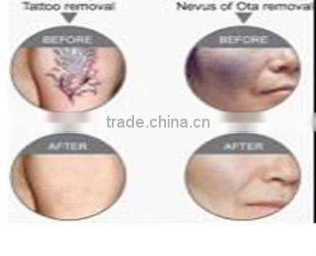 Hot Selling laser hair remove tattoo and hair removal laser equipment