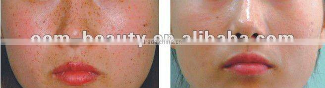 Permanent hair removal freckle removal stretch mark removal beauty machine C006