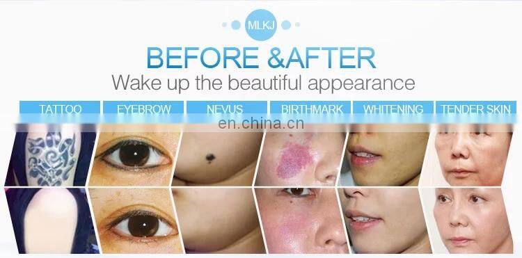 New nd yag laser/ laser hair removal machine price/ laser tattoo removal machine for sale