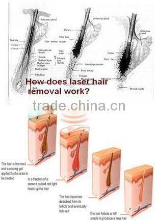 Portable China Beauty Salon Equipment With 808 Semiconductor Laser Painless Hair Removal