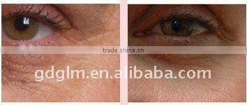 E-light permanent hair removal instrument E-009