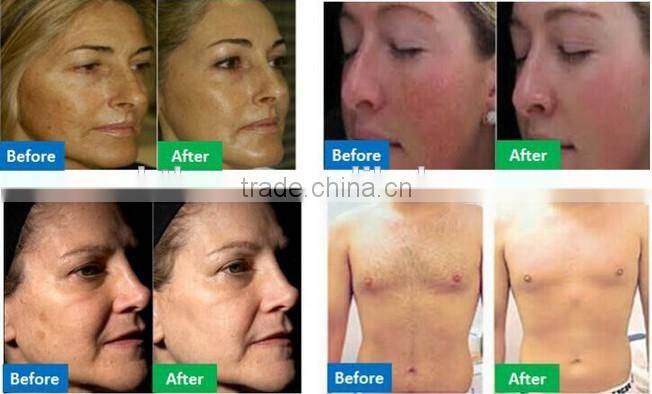 hot Korea home use IPL two function skin care beauty effect hair loose and skin rejuvenation