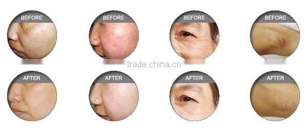 Manufacturer supply 3 handles IPL machine for hair removal skin rejuvenation veins removal