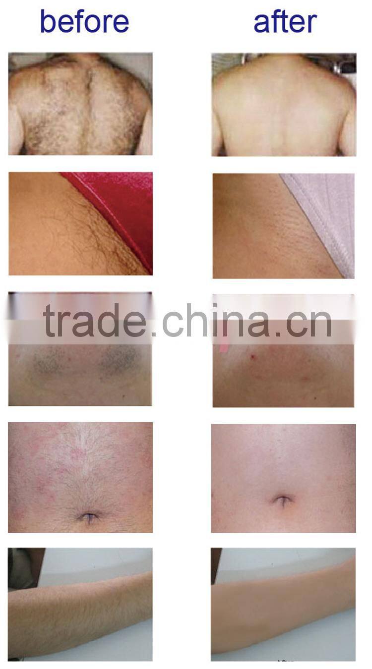 Strong Power!! Factory direct sale epilator laser hair removal machine 808nm diode equipment