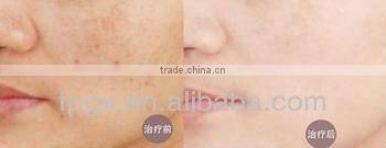 Professional Two handles ipl/rf hair removal machine
