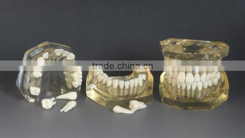 Dental detachable transparent dentition model DEA-47