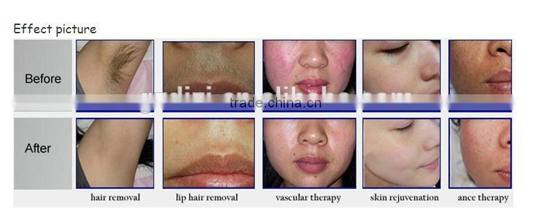 Medical aesthetic equipment hair remove machine, shr opt ipl hair removal laser, laser hair removal machine for sale