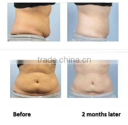 2015 New Weight Loss cavitation&rf&lipo body slimming laser machine