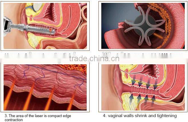 Lingmei medical scar removal co2 fractional aesthetic laser equipment