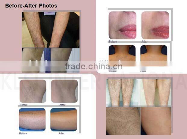 Distributors Wanted KLSi Top Quality 808nm Diode Laser Permanent Hair Removal machine